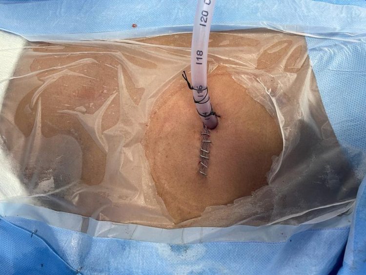 बड़ी खबर: डॉक्टरों ने एक ही छेद से किया आहार नली के कैंसर का ऑपरेशन।पढ़िए पूरी खबर