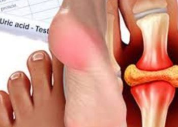 How To Reduce Uric Acid in Winter: शार्दियो में इन चीजों से बना लें दूरी, दूर होगा जोड़ों में जमा यूरिक एसिड