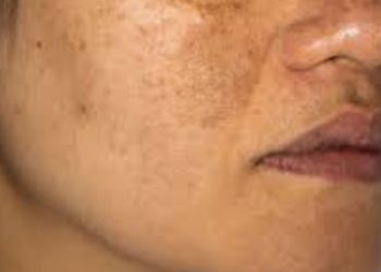 Pigmentation Home Remedies: यदि चेहरे से नही हट रही है झाइयां, तो यह होममेड सीरम का करे इस्तेमाल