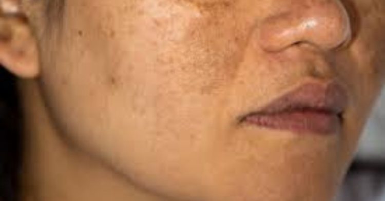 Pigmentation Home Remedies: यदि चेहरे से नही हट रही है झाइयां, तो यह होममेड सीरम का करे इस्तेमाल