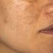 Pigmentation Home Remedies: यदि चेहरे से नही हट रही है झाइयां, तो यह होममेड सीरम का करे इस्तेमाल