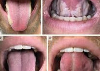 Health news : जीभ पर दिखने लगे ये 3 बदलाव तो हो जाइए सावधान,जल्द हो सकती है किडनी खराब