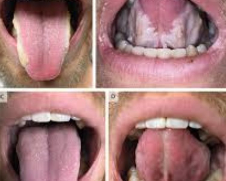 Health news : जीभ पर दिखने लगे ये 3 बदलाव तो हो जाइए सावधान,जल्द हो सकती है किडनी खराब