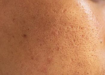 चेहरे पर रोमछिद्र नहीं रहेंगे, सिर्फ 3 चीज़ों से करें इलाज — रिज़ल्ट देख चौंक जाएंगे!