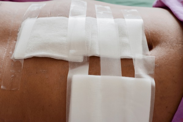 देहरादून: निजी अस्पताल की लापरवाही से महिला की मौत, सिजेरियन के बाद पेट में छूट गई कॉटन पट्टी