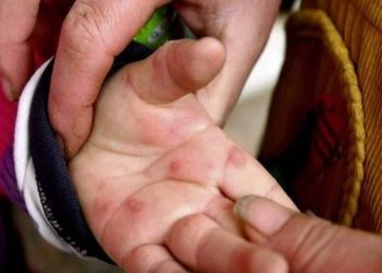 उत्तराखंड में टोमेटो फ्लू अलर्ट: 28 बच्चे बीमार, तीन जिलों में एडवाइजरी जारी