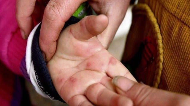 उत्तराखंड में टोमेटो फ्लू अलर्ट: 28 बच्चे बीमार, तीन जिलों में एडवाइजरी जारी