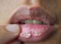 Dry Lips in Winter: सर्दियों में फटे होंठों से पाए निजात। जानें कारण और उपाय