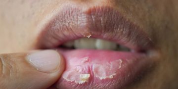 Dry Lips in Winter: सर्दियों में फटे होंठों से पाए निजात। जानें कारण और उपाय