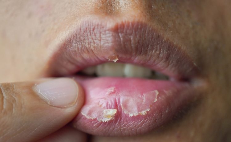 Dry Lips in Winter: सर्दियों में फटे होंठों से पाए निजात। जानें कारण और उपाय