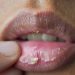 Dry Lips in Winter: सर्दियों में फटे होंठों से पाए निजात। जानें कारण और उपाय