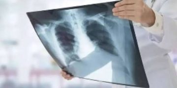 बड़ी खबर : देहरादून बना टीबी हॉटस्पॉट, पहाड़ में पौड़ी सबसे ज्यादा प्रभावित