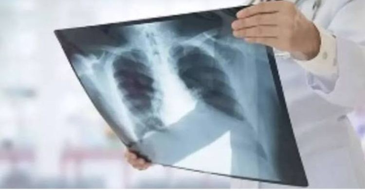 बड़ी खबर : देहरादून बना टीबी हॉटस्पॉट, पहाड़ में पौड़ी सबसे ज्यादा प्रभावित